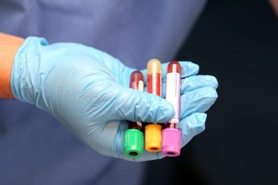 Gloved hand holding three tubes of Down syndrome biological samples